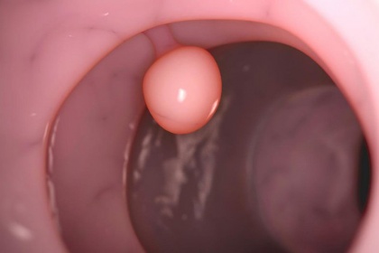 Polyp thực quản: Khi nào cần phẫu thuật?