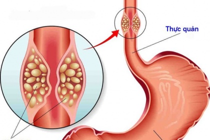 Cắt thực quản qua nội soi ngực bụng điều trị ung thư thực quản