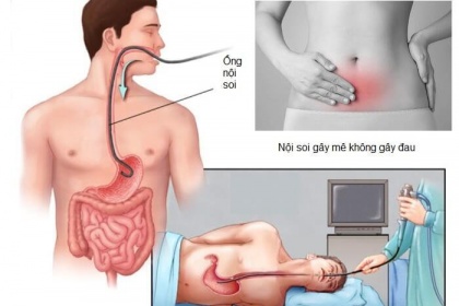 Phác đồ gây mê dạ dày đầy