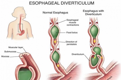 Ảnh hưởng của túi thừa thực quản