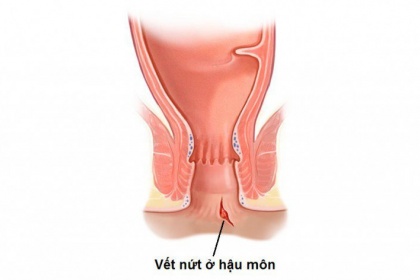 Xử trí vết thương hậu môn trực tràng