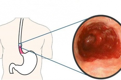 Điều trị hẹp miệng nối thực quản sau phẫu thuật