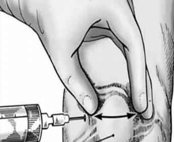Tiêm corticoid vào khớp có hại gì? và Những điều cần lưu ý