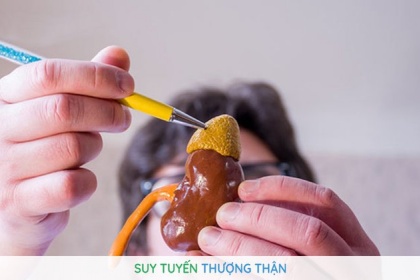 Suy tuyến thượng thận do Lạm dụng corticoid?