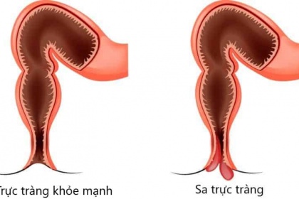 Điều trị sa trực tràng bằng mổ nội soi