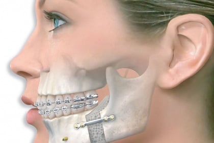 Quy trình chụp cắt lớp vi tính hàm mặt có tiêm thuốc đối quang theo mặt phẳng axial v