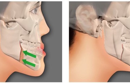 Quy trình chụp cắt lớp vi tính hàm mặt không tiêm thuốc đối quang theo mặt phẳng axia