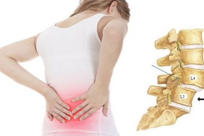 Phẫu thuật điều trị trượt đốt sống thắt lưng