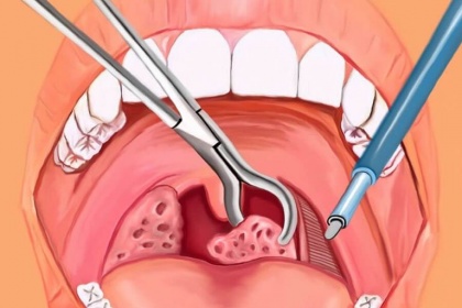 Chảy máu sau cắt Amidan: Cách xử trí, theo dõi
