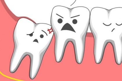 Khi nào cần chụp x quang răng khôn?