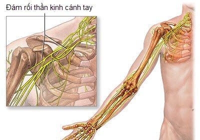 Gây tê đám rối thần kinh cánh tay phẫu thuật nội soi thoái hóa khớp cùng đòn