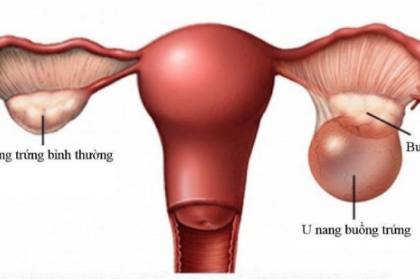 Gây mê nội khí quản phẫu thuật cắt u buồng trứng hoặc bóc u buồng trứng