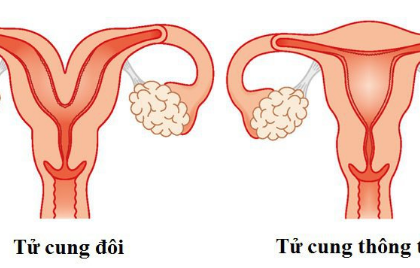 Gây mê nội khí quản phẫu thuật dị dạng tử cung