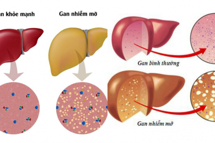 Gan nhiễm mỡ độ mấy là nặng? Điều trị như thế nào