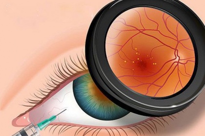 Hướng dẫn chăm sóc tại nhà cho người bị thoái hóa điểm vàng thể ướt