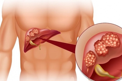Dấu hiệu nhận biết viêm gan C