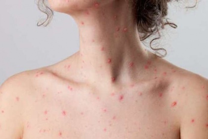 Bệnh thủy đậu có thể gây biến chứng nặng không?