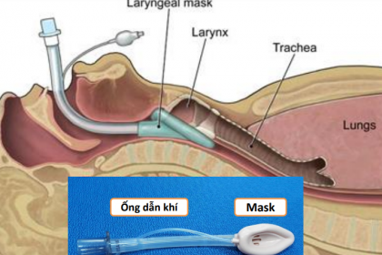 Gây mê mask thanh quản phẫu thuật nội soi xẻ sa lồi lỗ niệu quản