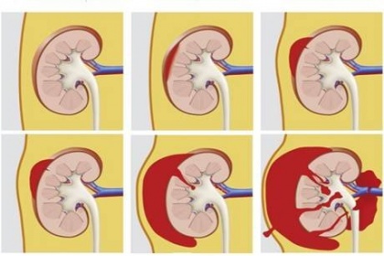 Chấn thương thận kín: Những điều cần biết