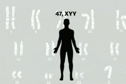 Tìm hiểu Hội chứng 47,XYY