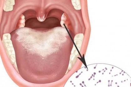 Bạch hầu là bệnh gì, Tại sao bạn bị bệnh bạch hầu?