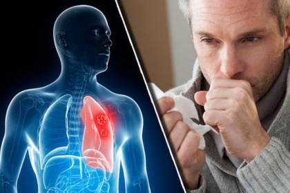 Phân biệt ho do ung thư phổi và bệnh thông thường