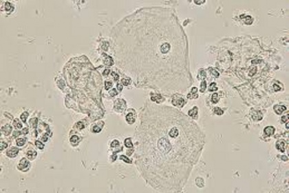 Tế bào Clue cell trong xét nghiệm soi tươi vi khuẩn âm đạo