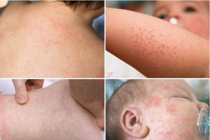 Triệu chứng nặng của sốt xuất huyết ở người lớn và trẻ em