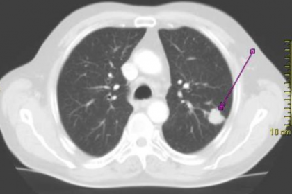 Ung thư phổi có thể được phát hiện ở giai đoạn sớm không?