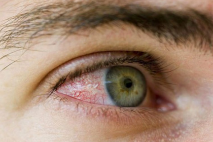 Viêm màng bồ đào gây ra những vấn đề gì về mắt?