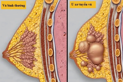 U xơ tuyến vú có khả năng tiến triển thành ung thư vú không?