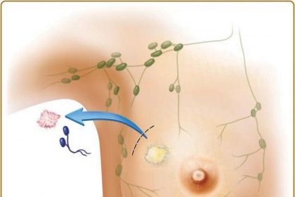 Điều trị bảo tồn tuyến vú cho bệnh nhân ung thư vú