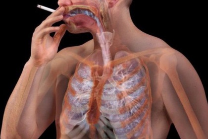 Bị giãn phế quản sau lao phổi