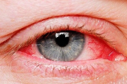 Cách chăm sóc cho trẻ bị đau mắt đỏ tại nhà như thế nào?