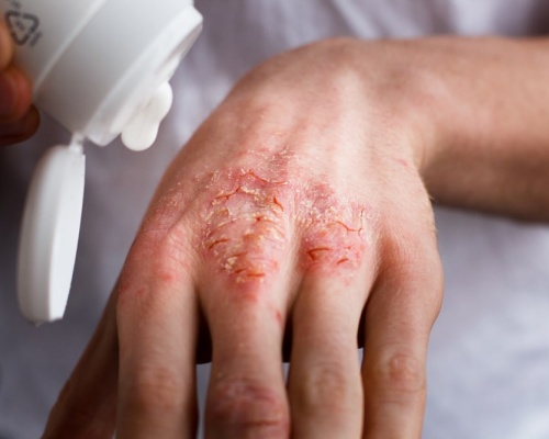 Ảnh của Celestoderm®
