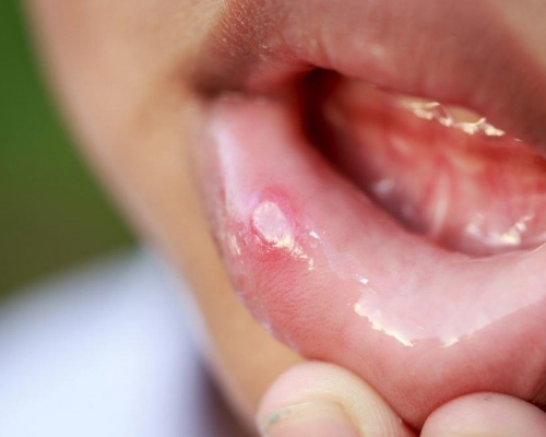 Ảnh của Oral Aid® Gel
