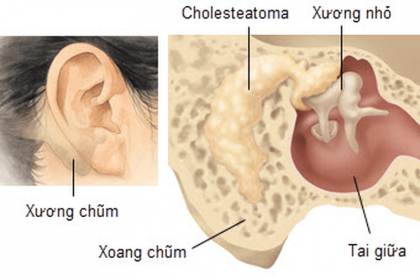 Có những tình trạng nào khác có triệu chứng tương tự viêm xương chũm ở trẻ em?
