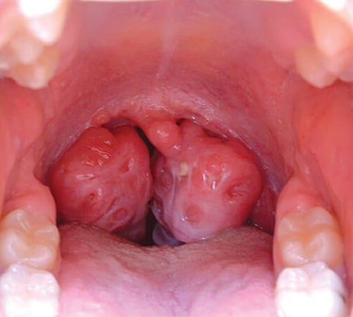 Những hình ảnh về bệnh ung thư vòm họng