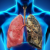 Các phương pháp điều trị ung thư phổi