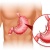 Hình ảnh nội soi viêm dạ dày và dạ dày bình thường