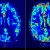 Chụp cộng hưởng từ tưới máu não (MRI perfusion) - P1