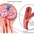 Chụp cộng hưởng từ tưới máu não (MRI perfusion) - P2