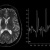 Chụp cộng hưởng từ phổ não (spect tính rography)