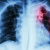 Chẩn đoán hình ảnh lao phổi