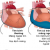 Các nguyên nhân gây tràn dịch ngoài màng tim