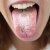Nhiễm nấm Candida ở miệng, cổ họng và thực quản