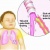 Triệu chứng viêm phế quản co thắt ở trẻ
