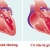 Bệnh cơ tim giãn: biểu hiện, nguyên nhân và cách điều trị
