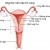 Ung thư nội mạc tử cung là gì? và cách phát hiện