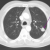 Ung thư phổi có thể được phát hiện ở giai đoạn sớm không?